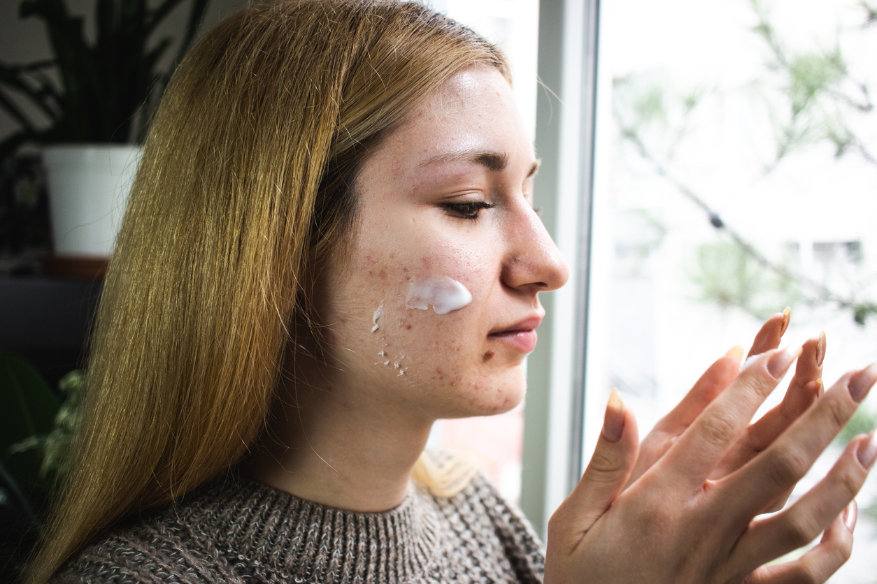 Topical treatment methods in acne treatment